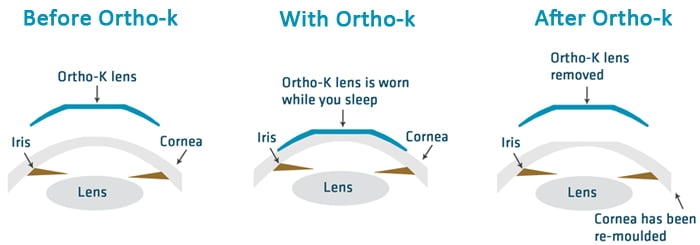 Apa Itu Orthokeratology?