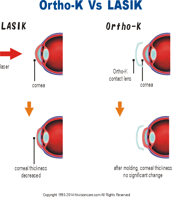 Ortho K vs Lasik