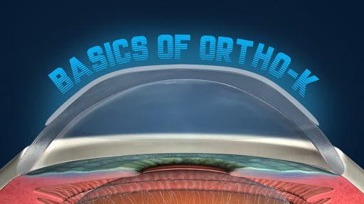 Solusi Rabun Jauh yang Praktis dan Efektif dengan Ortho K