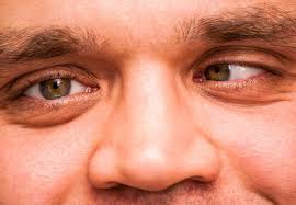 Strabismus (Mata Juling) yang Bisa Mempengaruhi Penglihatan