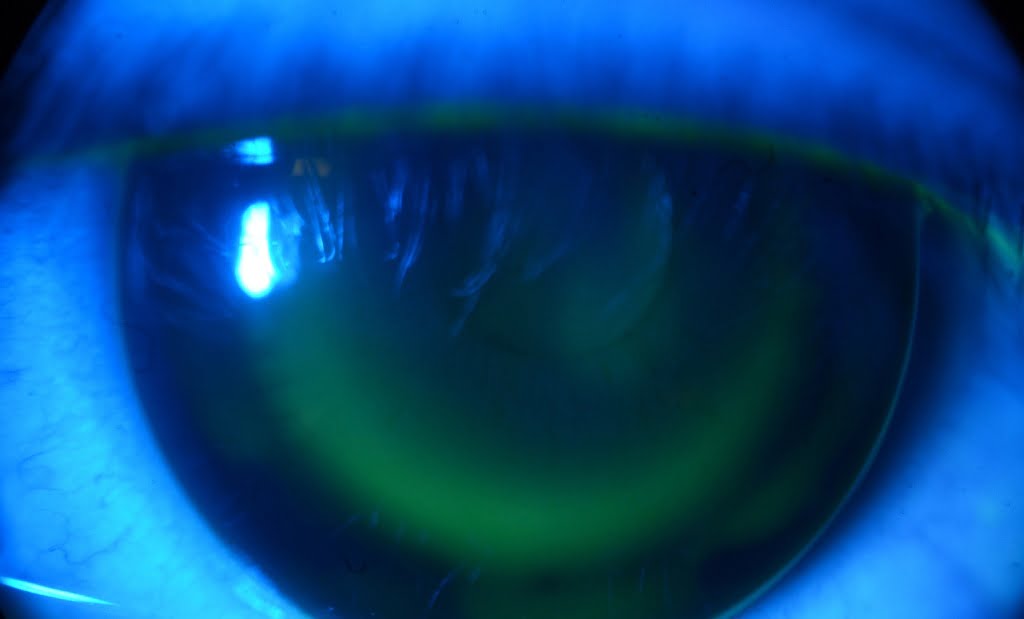 Mempelajari Manfaat yang Dihadirkan Orthokeratology untuk Kualitas Penglihatan