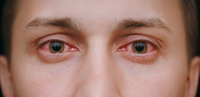 Langkah Vision Therapy yang Bisa Dilakukan Penderita Degenerasi Makula