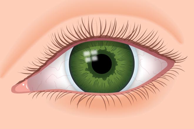 Tahukah Anda Rigid Gas Permeable Lens untuk Mata Minus Tinggi?