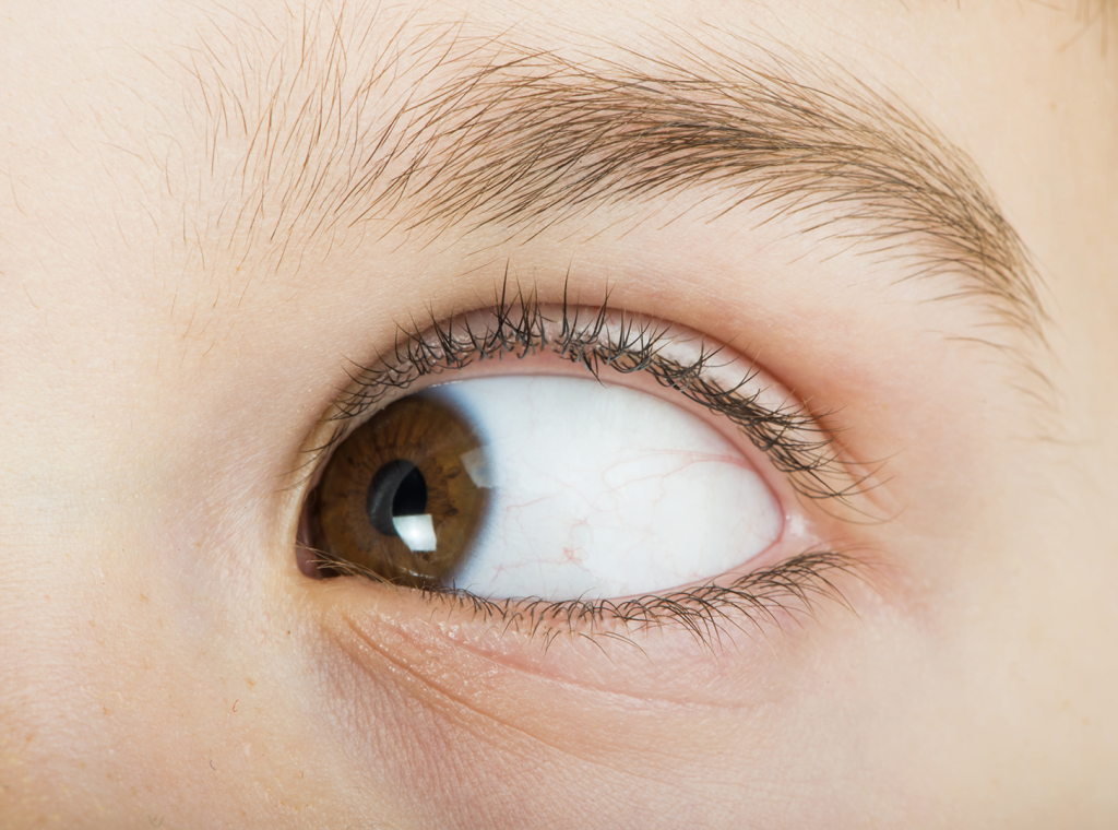 Atasi Masalah Strabismus dengan Vision Therapy