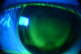 Kenali Apa Orthokeratology dan Manfaatnya