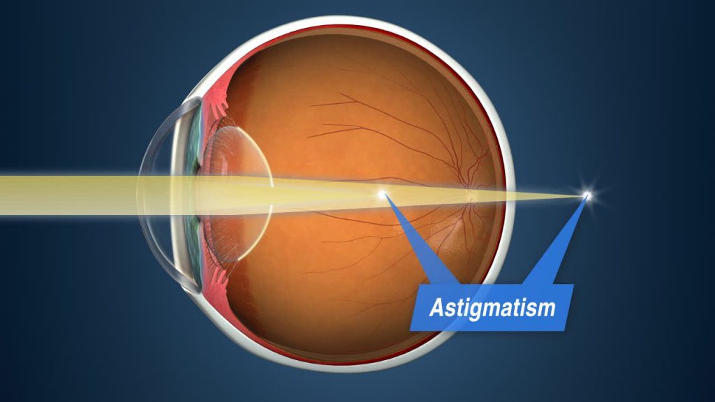 Cegah Rabun Jauh (Miopia) Memburuk dengan Lensa Khusus Orthokeratology