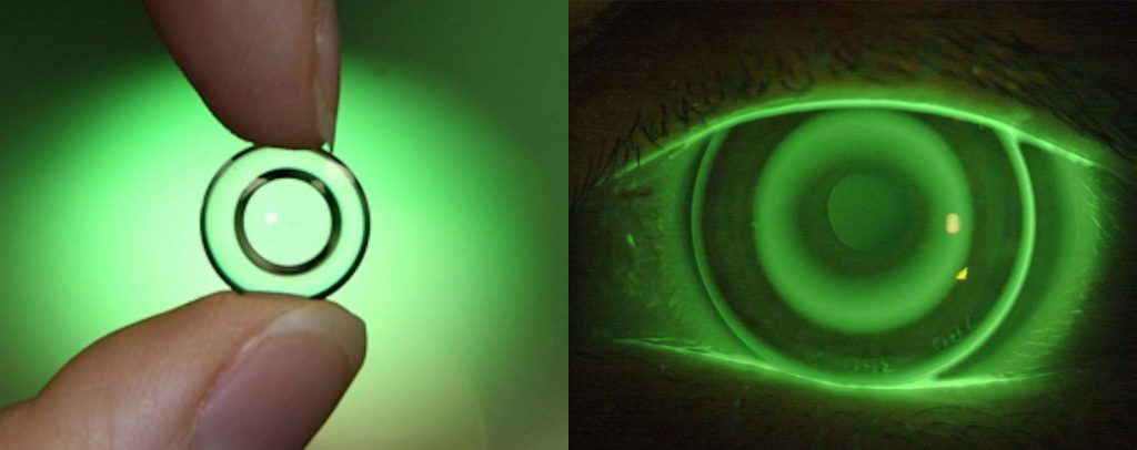 Cara Kerja Orthokeratology dan Manfaatnya