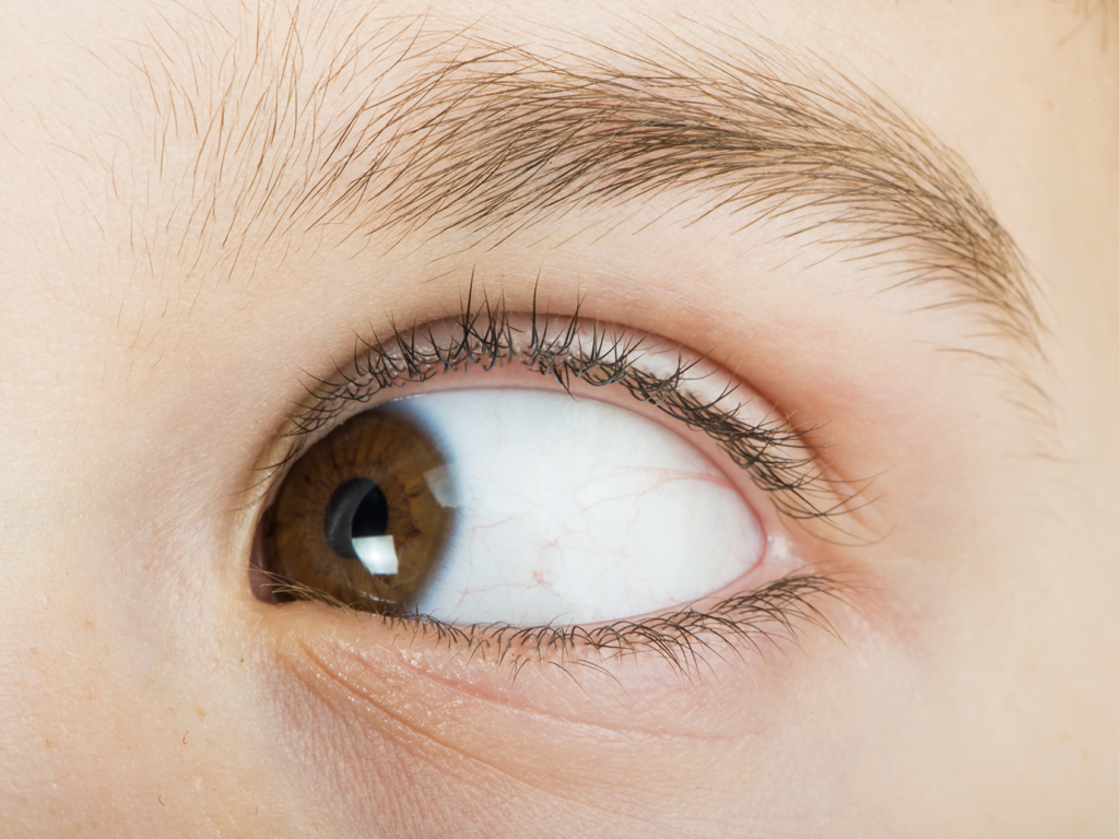 Mata Juling (Strabismus) Dapat Diperbaiki di Klinik Ganggguan Mata