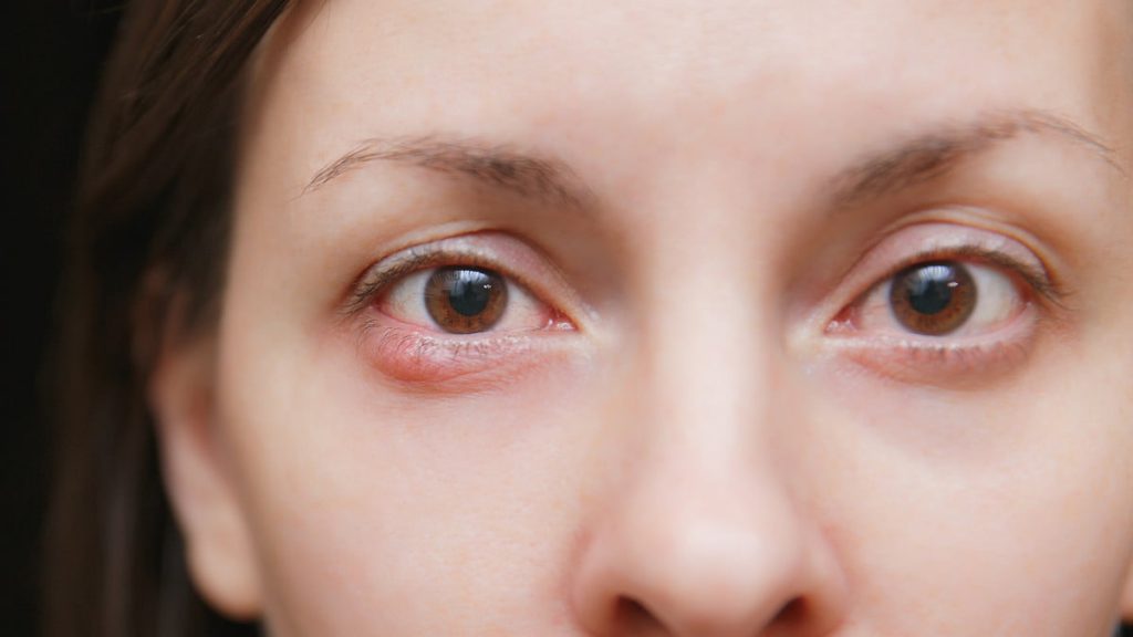 Waspadai Terjadinya Ablasi Retina Karena Mata Minus