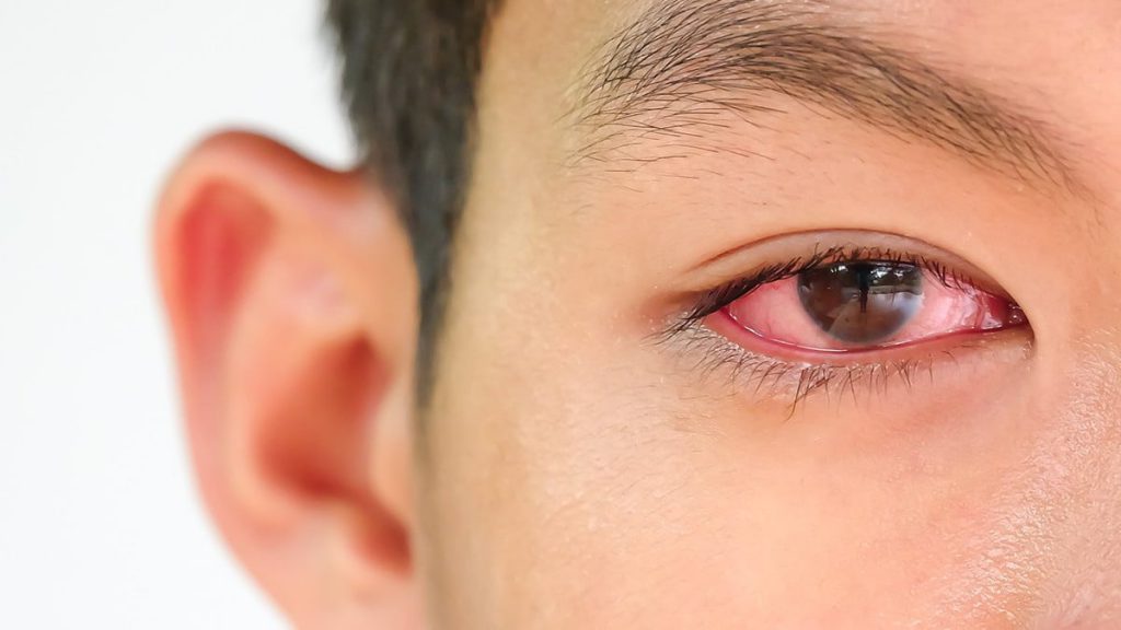 Pelajari tentang Gangguan Mata Konjungtivitis
