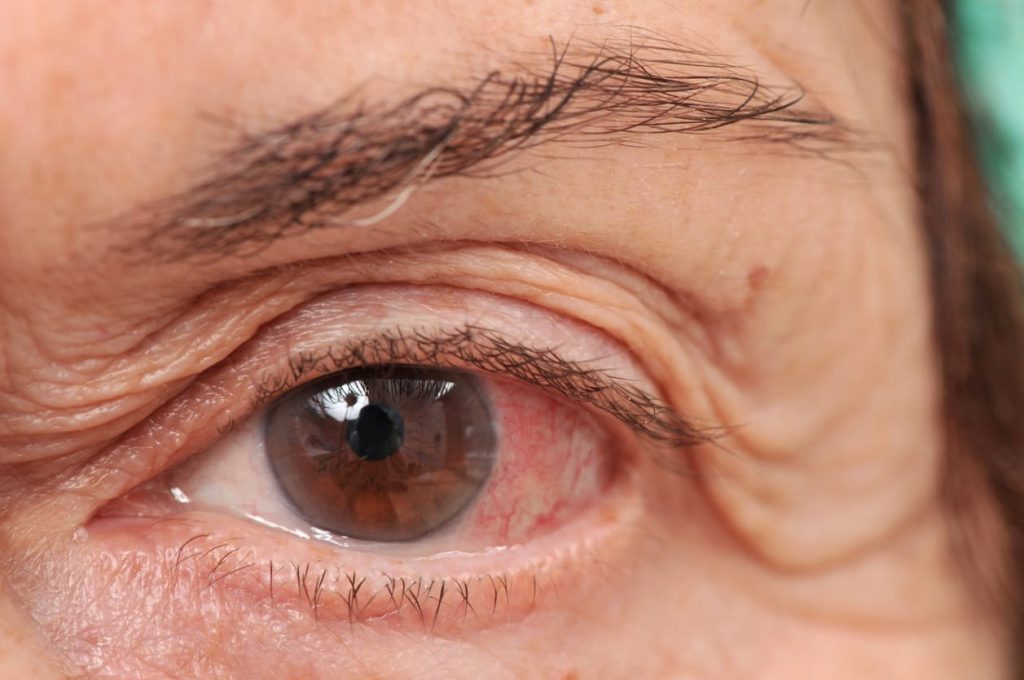 Pelajari tentang Gangguan Penglihatan Retinopati Diabetik