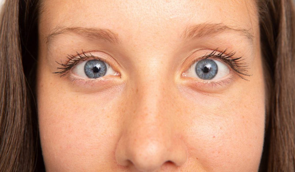 Kondisi Strabismus (Silang Mata), Tips Memperbaiki Keseimbangan Otot Mata dengan Vision Therapy