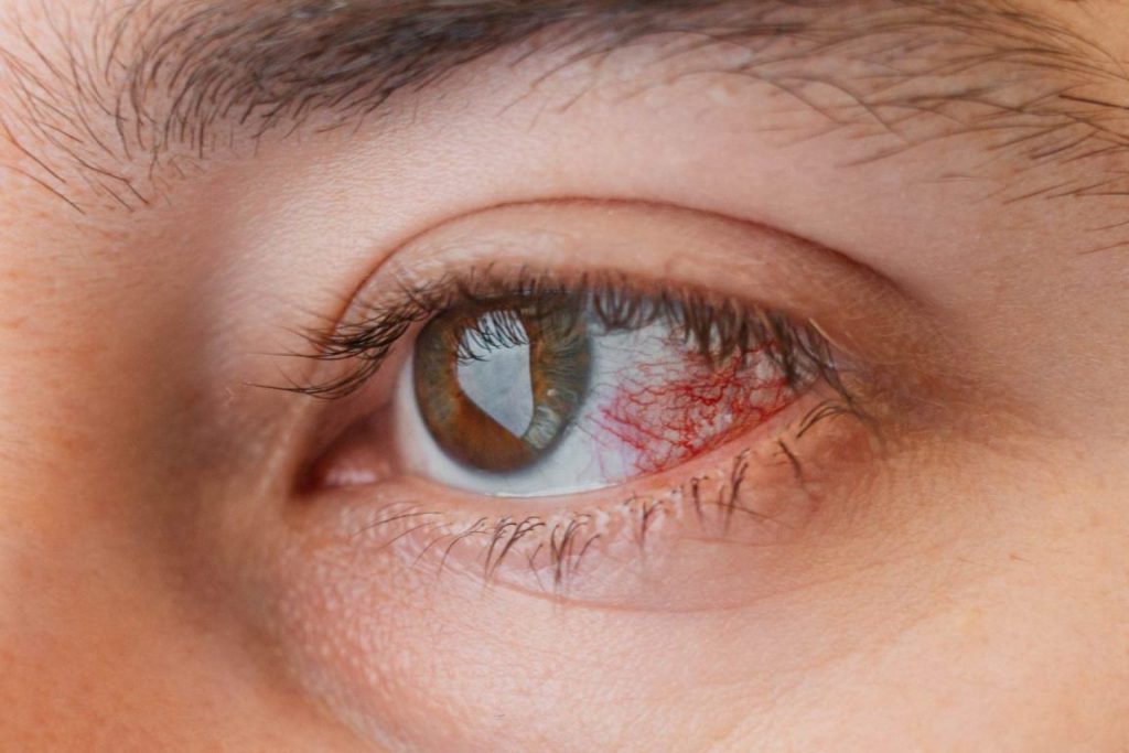 Mengenal Keratitis, Gangguan Penglihatan yang Harus Diwaspadai