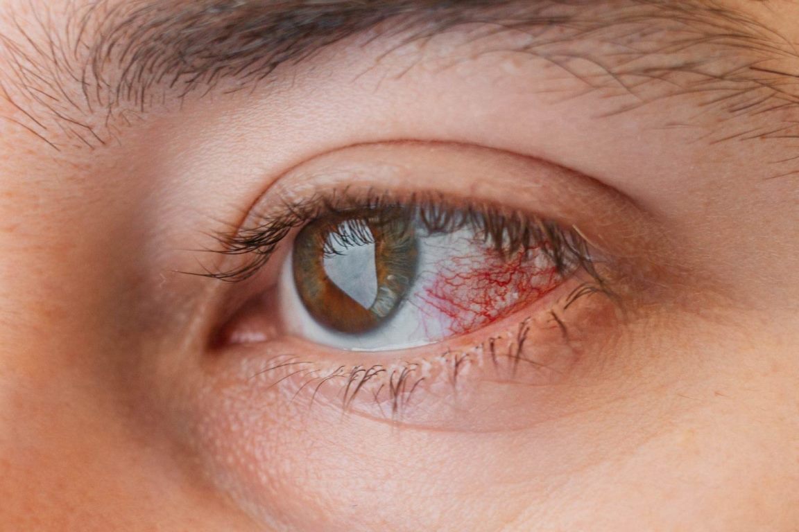 Mengenal Keratitis, Gangguan Penglihatan yang Harus Diwaspadai - VIO Optical Clinic