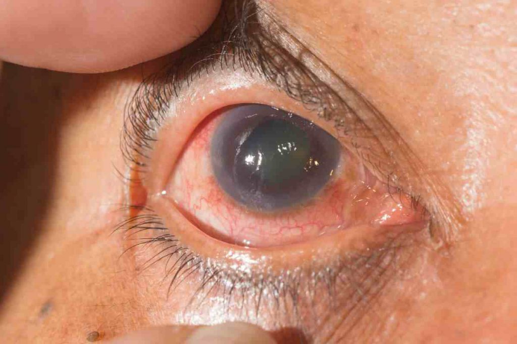 Memahami Glaukoma dan Gejalanya Sebagai Penyakit Mata Serius, Jangan Sampai Berakhir Low Vision