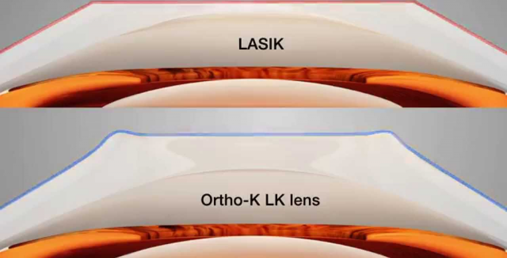 Apa Bedanya Antara Ortho-K dengan LASIK?