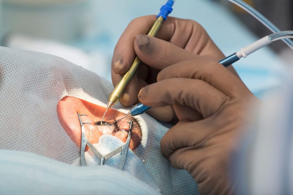 Mata Minus Bisa Kembali Setelah Menjalani Operasi LASIK?
