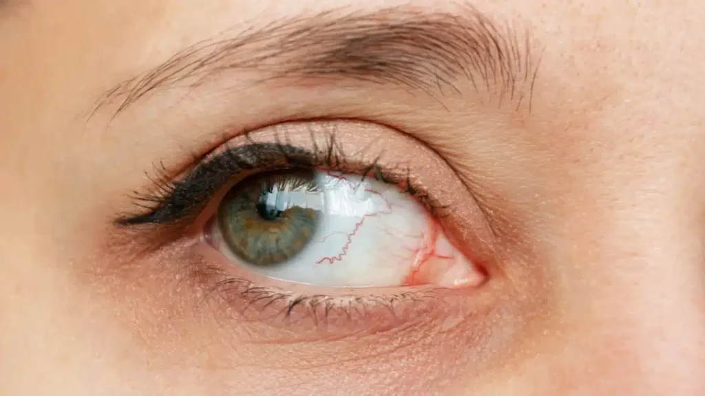 Apa yang Harus Dilakukan Saat Tiba-Tiba Terkena Keratitis?