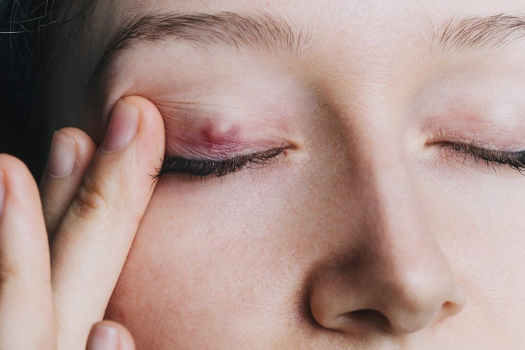 Apakah Bintitan Sama dengan Chalazion? Kenali Kedua Benjolan pada Mata