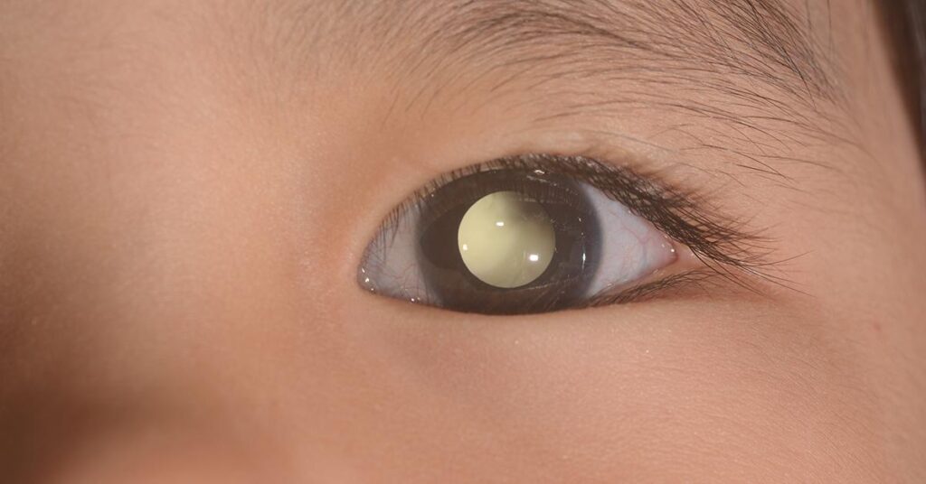Benarkah Kanker Mata Retinoblastoma Bisa Terjadi pada Anak-Anak?