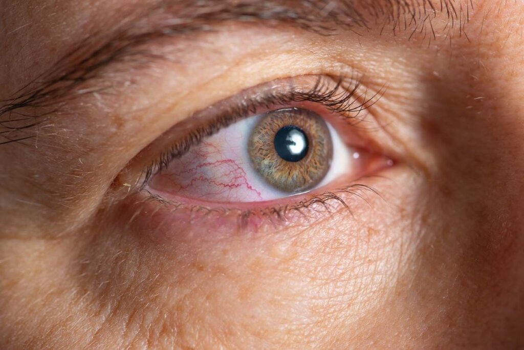 Mengatasi Berbagai Pink Eye dengan Datang ke Spesialisnya
