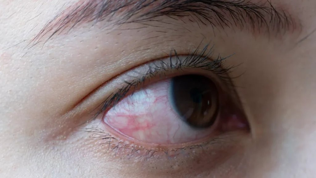 Mengenal Lebih Jauh Gangguan Penglihatan Serius Ablasio Retina